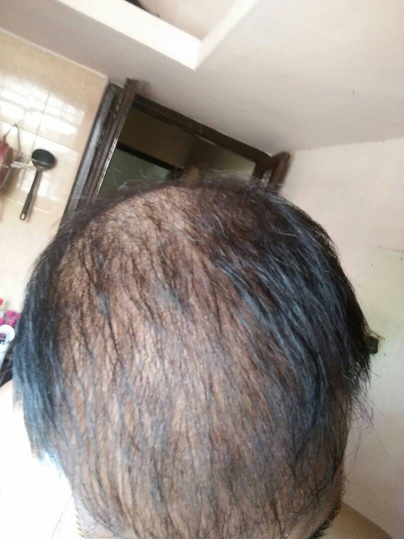 Diffuse Hair Loss Get More Vitamin B6 Regrow Your Hair Naturally