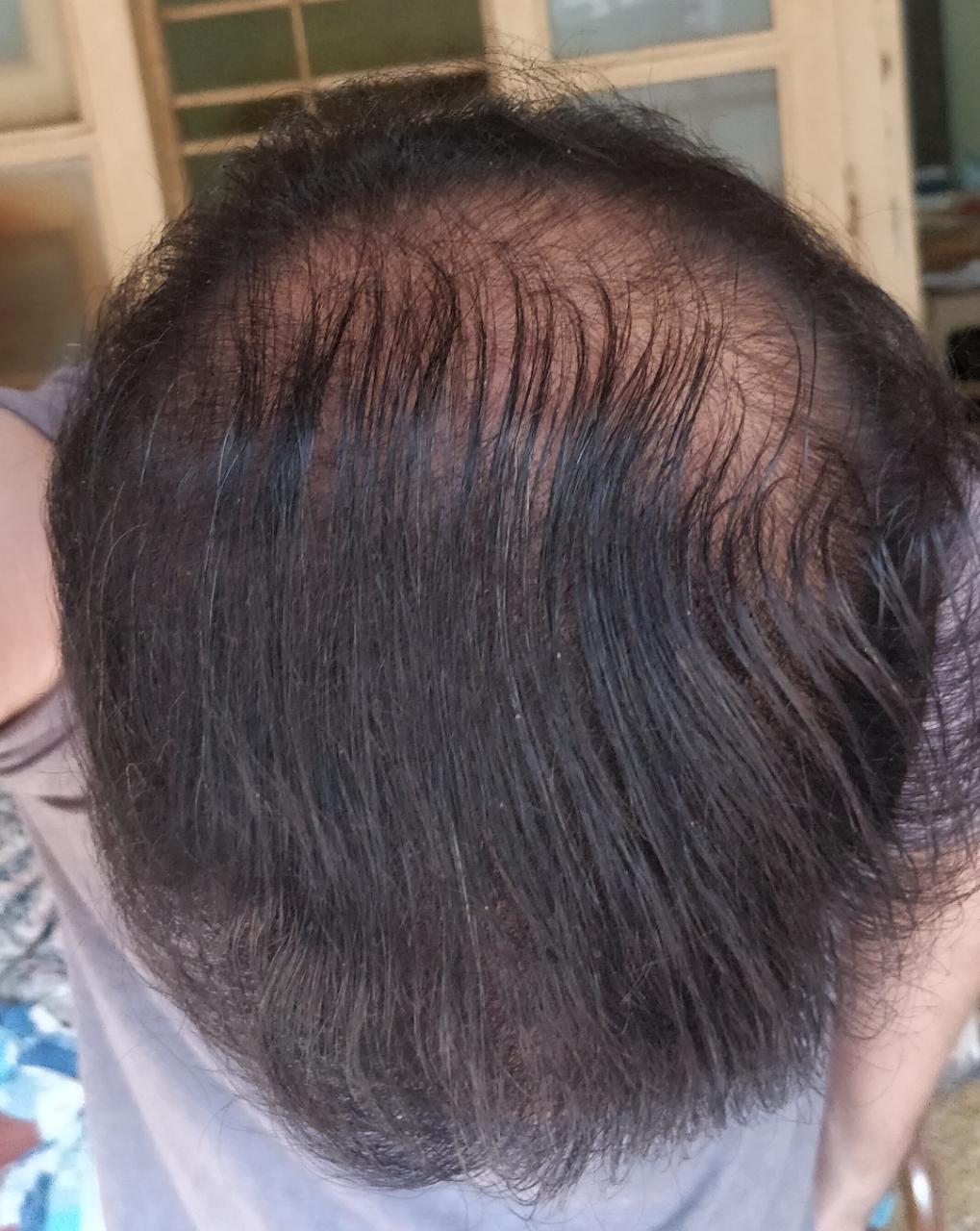 Nofap hair regrowth 7 Physical